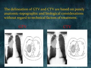 The delineation of GTV and CTV are based on purely
anatomic-topographic and biological considerations
without regard to technical factors of treatment.
GTV CTV
 
