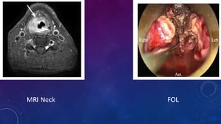 MRI Neck FOL
 