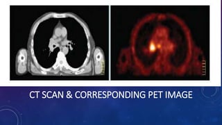 CT SCAN & CORRESPONDING PET IMAGE
 