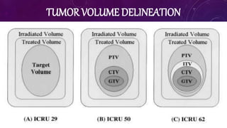 TUMOR VOLUME DELINEATION
 