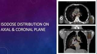 ISODOSE DISTRIBUTION ON
AXIAL & CORONAL PLANE
 