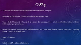 CASE 3
• 72 year old man with no urinary symptoms and a PSA level of 7.1 ng/ml.
• Digital Rectal Examination – Demonstrated enlarged prostate gland.
• Trans – Rectal Ultrasound – Showed 47 cc. prostate & a suspicious hypo – echoic nodule (10mm x 6mm x 16mm)
in left median peripheral zone.
• Double sextant core biopsy revealed Adenocarcinoma. 9/13 cores were positive. Gleason Score – 3 + 4 = 7 at left
base & 3 + 3 = 6 at all other sites.
• Stage – T1cN0M0
• Patient opted for radical radiotherapy.
 