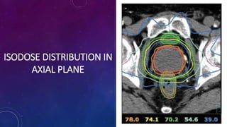 ISODOSE DISTRIBUTION IN
AXIAL PLANE
 