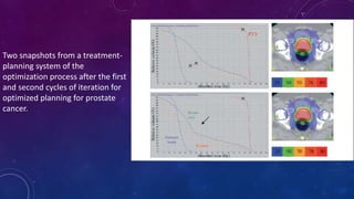 Two snapshots from a treatment-
planning system of the
optimization process after the first
and second cycles of iteration for
optimized planning for prostate
cancer.
 