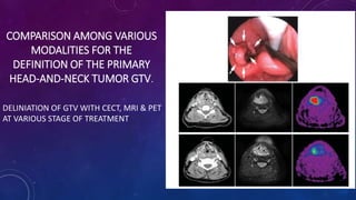 COMPARISON AMONG VARIOUS
MODALITIES FOR THE
DEFINITION OF THE PRIMARY
HEAD-AND-NECK TUMOR GTV.
DELINIATION OF GTV WITH CECT, MRI & PET
AT VARIOUS STAGE OF TREATMENT
 