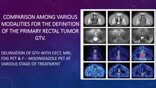 COMPARISON AMONG VARIOUS
MODALITIES FOR THE DEFINITION
OF THE PRIMARY RECTAL TUMOR
GTV.
DELINIATION OF GTV WITH CECT, MRI,
FDG PET & F – MISONIDAZOLE PET AT
VARIOUS STAGE OF TREATMENT
 