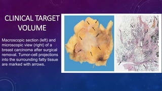 CLINICAL TARGET
VOLUME
Macroscopic section (left) and
microscopic view (right) of a
breast carcinoma after surgical
removal. Tumor-cell projections
into the surrounding fatty tissue
are marked with arrows.
 