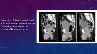 Illustration of the impact of rectal
volume [increase due to either gas
(middle) or stool (right)] on
prostate CTV displacement.
 