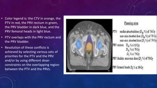 • Color legend is: the CTV in orange, the
PTV in red, the PRV rectum in green,
the PRV bladder in dark blue, and the
PRV femoral heads in light blue.
• PTV overlaps with the PRV rectum and
the PRV bladder.
• Resolution of these conflicts is
achieved by selecting various sets of
priorities for the PTV and the PRV
and/or by using different dose-
constraints on the overlapping region
between the PTV and the PRVs.
 