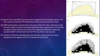 (A) Beam’s eye view (BEV) of a conventional tangential field (dashed outline). The
blue contour shows the PTV extending outside the breast to secure flash.
(B) IMRT optimization is performed on the part of the PTV a few millimeter inside
the skin surface to avoid (unwanted) absorbed-dose compensation in the build-
up region by the optimizer. No intensity is assigned to beamlets projecting
outside the BEV of the breast into the PTV; thus flash is not secured.
(C) Creation of flash by extending the same intensity values from the breast
periphery to the regions of the PTV outside the breast BEV.
 
