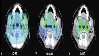 EVOLUTION OF IMAGING IN RADIOTHERAPY
X – Ray simulator based planning (based on bony landmarks)
CT scan based planning (co...