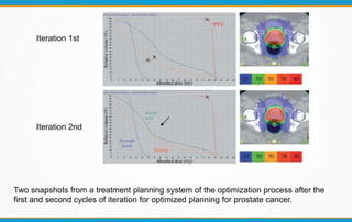 Two snapshots from a treatment planning system of the optimization process after the
first and second cycles of iteration for optimized planning for prostate cancer.
Iteration 1st
Iteration 2nd
 