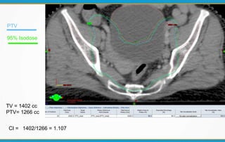 TV = 1402 cc
PTV= 1266 cc
CI = 1402/1266 = 1.107
PTV
95% Isodose
 