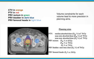 CTV in orange
PTV in red
PRV rectum in green
PRV bladder in dark blue
PRV femoral heads in light blue
Volume constraints for each
volume lead to more precision in
planning aims.
 