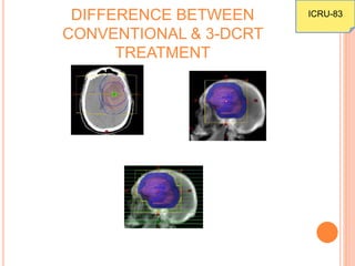 DIFFERENCE BETWEEN
CONVENTIONAL & 3-DCRT
TREATMENT
ICRU-83
 