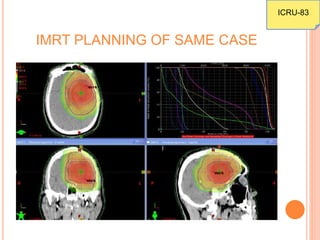 IMRT PLANNING OF SAME CASE
ICRU-83
 