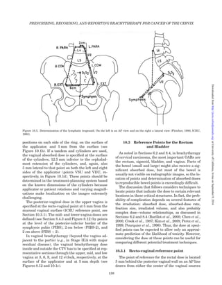positions on each side of the ring, on the surface of
the applicator, and 5 mm from the surface (see
Figure 10.1b). If a tandem and cylinders are used,
the vaginal absorbed dose is speciﬁed at the surface
of the cylinders, 12.5 mm inferior to the cephalad-
most extension of the cylinders, and, again, also
5 mm lateral to that point on both the left and right
sides of the applicator (points VSU and VDU, re-
spectively, in Figure 10.1d). These points should be
determined in the treatment-planning system based
on the known dimensions of the cylinders because
applicator or patient rotations and varying magniﬁ-
cations make localization on the images extremely
challenging.
The posterior-vaginal dose in the upper vagina is
speciﬁed at the recto-vaginal point at 5 mm from the
mucosal vaginal surface (ICRU reference point, see
Section 10.3.1). The mid- and lower-vagina doses are
deﬁned (see Section 8.4.3 and Figure 8.12) by points
at the level of the posterior-inferior border of the
symphysis pubis (PIBS), 2 cm below (PIBS-2), and
2 cm above (PIBS þ 2).
In vaginal brachytherapy (beyond the vagina ad-
jacent to the portio) (e.g., in Stage IIIA with major
residual disease), the vaginal brachytherapy dose
inside and outside the CTV has to be speciﬁed at rep-
resentative sections through the upper, mid, and low
vagina at 3, 6, 9, and 12 o’clock, respectively, at the
surface of the applicator and at 5 mm depth (see
Figures 8.12 and 10.1c).
10.3 Reference Points for the Rectum
and Bladder
As noted in Sections 6.2 and 8.4, in brachytherapy
of cervical carcinoma, the most important OARs are
the rectum, sigmoid, bladder, and vagina. Parts of
the bowel (small and large) might also receive a sig-
niﬁcant absorbed dose, but most of the bowel is
usually not visible on radiographic images, so the lo-
cation of points and determination of absorbed doses
to reproducible bowel points is exceedingly difﬁcult.
The discussion that follows considers techniques to
locate points that indicate the dose to certain relevant
locations in these critical structures. In fact, the prob-
ability of complication depends on several features of
the irradiation: absorbed dose, absorbed-dose rate,
fraction size, irradiated volume, and also probably
complex dose–volume relationships, as discussed in
Sections 6.2 and 8.4 (Barillot et al., 2000; Chen et al.,
2000; Crook et al., 1987; Kim et al., 2008; Perez et al.,
1999; Pourquier et al., 1996). Thus, the dose at speci-
ﬁed points can be expected to allow only an approxi-
mate prediction of the likelihood of toxicity. However,
considering the dose at these points can be useful for
comparing different potential treatment techniques.
10.3.1 Recto-vaginal reference point
The point of reference for the rectal dose is located
5 mm behind the posterior vaginal wall on an AP line
drawn from either the center of the vaginal sources
Figure 10.5. Determination of the lymphatic trapezoid. On the left is an AP view and on the right a lateral view (Fletcher, 1980; ICRU,
1985).
PRESCRIBING, RECORDING, AND REPORTING BRACHYTHERAPY FOR CANCER OF THE CERVIX
138
atUniversityofCalifornia,IrvineonSeptember9,2016http://jicru.oxfordjournals.org/Downloadedfrom
 