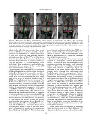u ¼ p=2
ð11:6Þ
The introduction of the geometric function as deﬁned
in Equation (11.6) removes the effects of the geometry
from the radial absorbed-dose function when taking
the ratio of the doses at the two distances (1 cm and r).
Fl(r,u) is the anisotropy function. This function
accounts for the angular variation of absorbed-dose
rate around the source due to ﬁltration of the encap-
sulation and internal components and scatter in the
medium, and is a function of the distance and angle.
To eliminate purely geometric effects, the absorbed-
dose rate is divided by the geometry function at that
point. The equation for the anisotropy function is
Flðr; uÞ ¼
_DðuÞ Â Glðu ¼ p=2Þ
_Dðu ¼ p=2Þ Â GlðuÞ
 