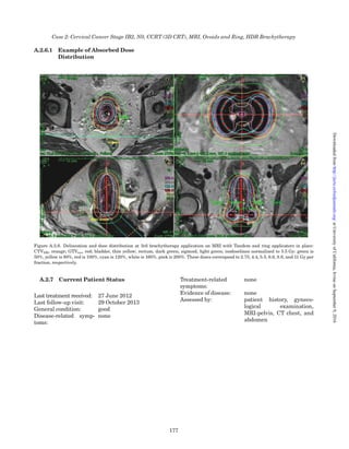 Applied PTV
margin:
10 mm
Patient positioning: supine position (cushion
supporting the knees)
Planning
technique:
3DCRT, four Field box
Conformal nodal boost was
planned to give:
8 Gy in 4 fractions to the left and
right low external iliac macroscop-
ic lymph nodes PTVand 12 Gy in
6 fractions to the upper right
external iliac lymph node. An
anterior–posterior conformal
technique using 20 MV photon
energy was used with two oblique
ﬁelds parallel to the brachyther-
apy isodose shape.
Concomitant
therapy:
5 weekly cycles of cisplatin
40 mg m22
Overall treatment
time:
CTV-T þ N1 33 days
CTV-N2 46 days
CTV-N3 50 days
A.1.5 Brachytherapy
A.1.5.1 Gynecological Examination at the
Time of Brachytherapy (Figure A.1.4)
Tumor extension: no residual tumor
Estimated
cervical size:
2.5 Â 2.5 cm (width Â thickness)
Figure A.1.3. Dose distribution of EBRT. The pelvis itself (PTV-T and PTV-N1) was treated with 45 Gy in 25 fractions. A conformal boost
with two opposed ﬁelds of 8 Gy in 4 fractions were delivered to the 2 pathological nodes (PTV-N2) along the external iliac vessels
bilaterally plus a complementary boost of 4 Gy in 2 fractions on the upper right iliac external node (PTV-N3), taking the brachytherapy
dose contribution into account.
Table A.1.2. Absorbed dose distribution for EBRT.
Target Volume Planning aim V95 %
a
D98 % D50 % D2 %
PTV-T þ N1 841 cm3
45 Gy 100 % 44.7 Gy 46.6 Gy 47.6 Gy
V43 Gy 1089 cm3
V57 Gy 57 cm3
Organs at risk V35 Gy V45 Gy V50 Gy V55 Gy D98 % D50% D2%
Bladder 100 % 99.3 % 3.8 % 0 45.6 Gy 46.7 Gy 52.3 Gy
Rectum 78.2 % 40.5 % 0 0 33.4 Gy 43 Gy 46.4 Gy
Sigmoid 93.2 % 78.7 % 33.1 % 12.1 % 33.5 Gy 47.7 Gy 58.7 Gy
Bowel bag 385 cm3
378 cm3
156 cm3
66 cm3
19.5 Gy 47.8 Gy 58.9 Gy
a
Volume treated to 95 % of the planning aim absorbed dose.
Case 1: Cervical Cancer Stage IB1, N1, CCRT (3D CRT) (LN Boost), MRI, mould, PDR Brachytherapy
167
atUniversityofCalifornia,IrvineonSeptember9,2016http://jicru.oxfordjournals.org/Downloadedfrom
 