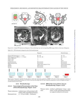 A.1.6.1 Example of Dose Distribution
A.1.7 Current Patient Status
Last treatment
received:
28 June 2007
Last follow-up visit: 11 January 2013
General condition: good
Disease-related
symptoms:
none
Treatment-related
symptoms:
menopausal symptoms
Treatment: hormonal replacement
therapy
Evidence of disease: none
Assessed by: gynecological examination,
MRI-pelvis and para-aortic
area
Figure A.1.6. Delineation and dose distribution at brachytherapy. Intermediate-risk CTV is in dotted blue line. High-risk CTV is in dotted
orange line. Red isodose corresponds to 100 % planning aim dose, i.e., 15 Gy EQD210 dose. Orange isodose corresponds to 200 % planning
aim dose, i.e., 30 Gy EQD210 dose. Yellow isodose corresponds to 267 % planning aim dose, i.e., 40 Gy EQD210 dose.
PRESCRIBING, RECORDING, AND REPORTING BRACHYTHERAPY FOR CANCER OF THE CERVIX
170
atUniversityofCalifornia,IrvineonSeptember9,2016http://jicru.oxfordjournals.org/Downloadedfrom
 