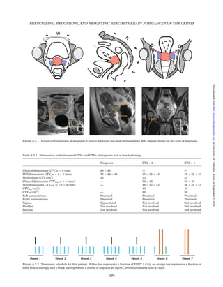 A.3.4.7 Example of Dose Distribution
A.3.5 Current Patient Status
Last treatment received: 4 February 2012
Last follow-up visit: 21 May 2014
General condition: good, works full time
Disease-related
complaints:
blood loss
Treatment-related
complaints:
after 27 months follow-up:
normal sexual intercourse
only complaints of sporadic
blood loss at intercourse, no
rectosigmoidal, or bladder
morbidity.
Evidence of disease: local recurrence, lymphnode
recurrence, inguinal right,
bilateral iliaca externa , bi-
lateral iliaca communis, low
para aortic
Assessed by: patient history, gyneco-
logical examination, PET–
CT
Figure A.3.6. Dose distribution for brachytherapy residual GTV (delineated in red), CTVHR (in green), CTVIR (in blue). The bladder is
delineated in yellow, the rectum in rose. Prescribed dose was 45.2 Gy to the D90 of the CTVHR. The isodoses are shown as: 165 Gy total
EQD2 (in white), 85 Gy total EQD2 (in green covering the CTVHR), 70 Gy EQD2 (in rose not entering the delineated rectum), and 60 Gy
total EQD2 (covering largely the CTVIR).
PRESCRIBING, RECORDING, AND REPORTING BRACHYTHERAPY FOR CANCER OF THE CERVIX
184
atUniversityofCalifornia,IrvineonSeptember9,2016http://jicru.oxfordjournals.org/Downloadedfrom
 