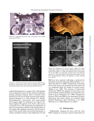 vaginal bleeding prior to surgery, often with ﬁndings
of an endometrial cancer. In the context of radiation-
therapy planning, however, there is limited recent
literature on the use of US for cervical cancer brachy-
therapy (Narayan et al., 2011; Schmid et al., 2013a).
Trans-abdominal, trans-rectal, and trans-vaginal
US imaging might be performed (see Figure 4.6).
Trans-vaginal US appears to be of less value due to
its limited view of the parametria for delineation of
extra-cervical disease and due to the limited space in
the vagina after applicator insertion. For the assess-
ment of the uterine body and cervical dimensions, a
strong correlation between trans-abdominal US and
MRI has been reported, indicating a potential for
US-based treatment planning (Mahantshetty et al.,
2012; Van Dyk et al., 2009). Furthermore, it has been
shown that tumor size measured by trans-rectal US
is a prognostic factor for relapse of cervical cancer
(Magee et al., 1991). The accuracy of trans-rectal
ultrasound (TRUS) for staging cervical cancer, com-
pared with the surgical ﬁndings, was reported in one
study as 83 % (Innocenti et al., 1992). Comparisons
between TRUS and MRI in the assessment of tumor
dimensions and tumor volume are currently being
debated (Fischerova, 2011; Fischerova et al., 2008;
Hawnaur et al., 1998; Schmid et al., 2013a).
4.6 Radiography
Radiographic imaging has been used for local
FIGO staging by assessing ureteral obstruction by
Figure 4.4. Enlarged para-aortic node, contoured in red, visible
on an axial CT slice.
Figure 4.5. 2-(Fluorine-18) ﬂuoro-2-deoxy-D-glucose PET-CTexam
revealing a large cancer of the cervix on the left and multiple
internal and common iliac nodes with increased FDG activity.
Figure 4.6. Ultrasound of cervical cancer: vaginal 3D endo-
sonography of bulky cervical cancer inﬁltrating into the uterine
corpus [from Figure 1.1. (Olpin and Tempany, 2011)]; trans-rectal
US (b) and MRI (c) of advanced cervical cancer with bilateral
proximal (1) and right distal (2) parametrial involvement at the
time of brachytherapy without the applicator in place (Schmid
et al., 2013a).
Brachytherapy Imaging for Treatment Planning
41
atUniversityofCalifornia,IrvineonSeptember9,2016http://jicru.oxfordjournals.org/Downloadedfrom
 