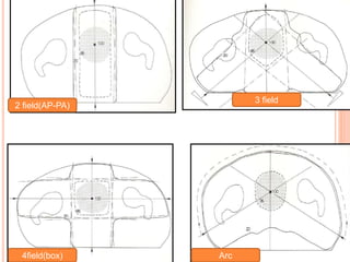 2 field(AP-PA)
3 field
4field(box) Arc
 