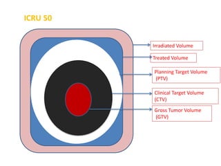 ICRU 50
Irradiated Volume
Treated Volume
Planning Target Volume
(PTV)
Clinical Target Volume
(CTV)
Gross Tumor Volume
(GTV)
 