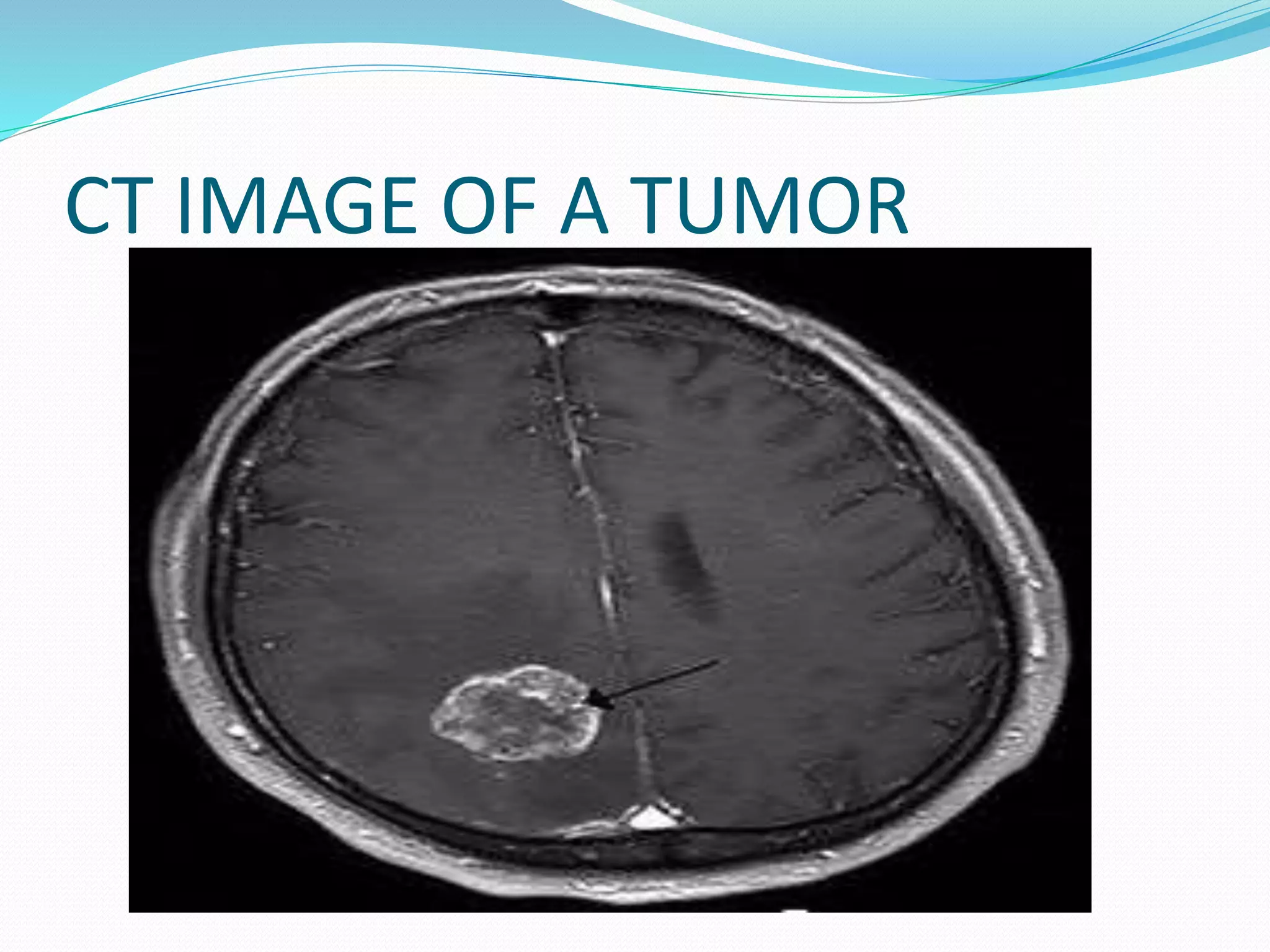 CT IMAGE OF A TUMOR
 