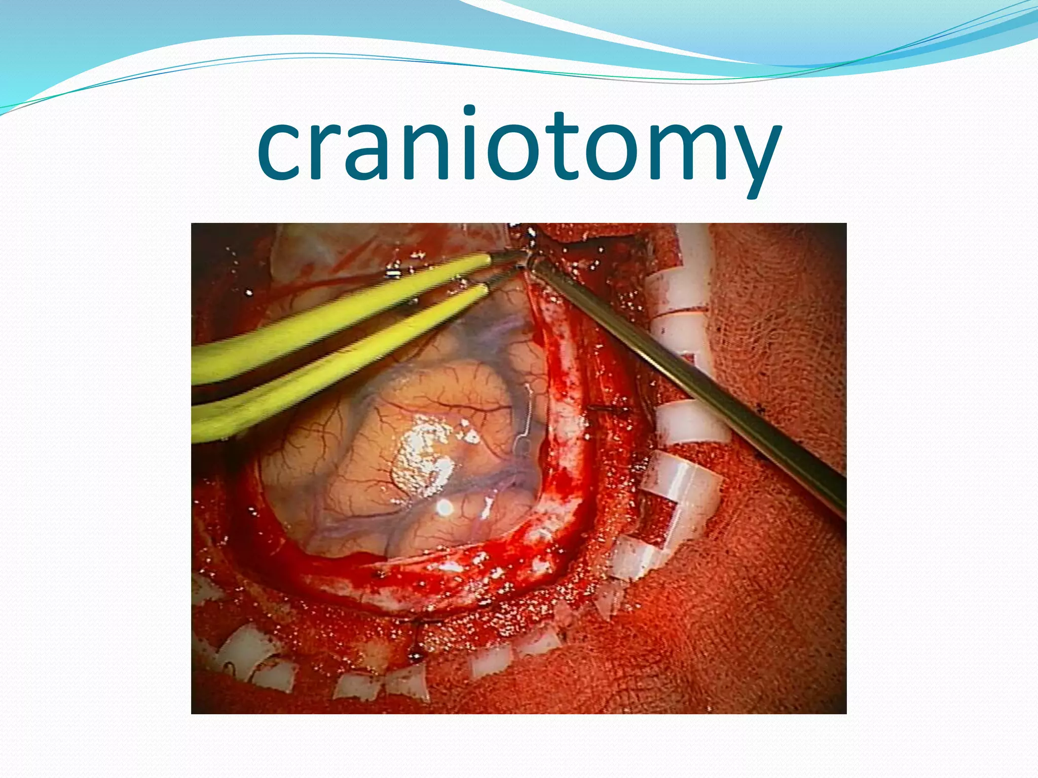 craniotomy
 