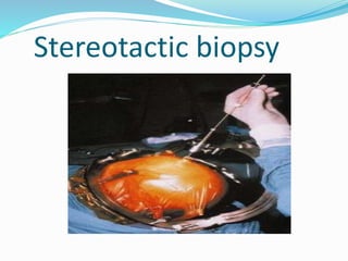 Stereotactic biopsy
 