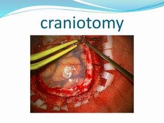 craniotomy
 