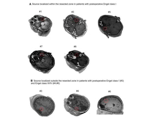 Ictal EEG source imaging | PPTX