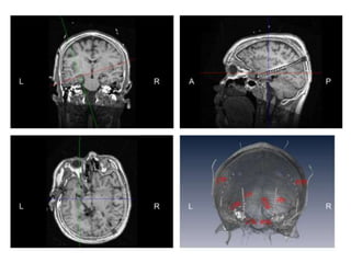 Ictal EEG source imaging | PPTX