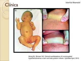 Icterícia Neonatal
Clínica




          Wong RJ, Bhutani VK. Clinical manifestations of unconjugated
          hyperbilirubinemia in term and late preterm infants. Uptodate April, 2012.
 