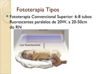 Fototerapia Tipos
 FototerapiaConvencional Superior: 6-8 tubos
 fluorescentes paralelos de 20W, a 20-50cm
 do RN
 