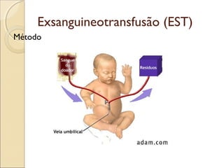 Exsanguineotransfusão (EST)
Método
 