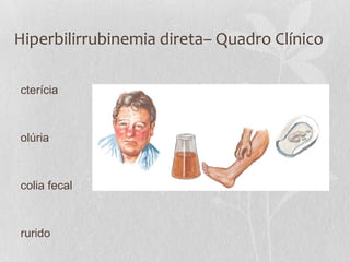 Hiperbilirrubinemia direta– Quadro Clínico
cterícia
olúria
colia fecal
rurido
 