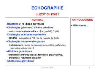 Claude EUGENE
 
ECHOGRAPHIE 
 
b) ETAT DU FOIE ?
NORMAL
- Hépatites (++) (diapo suivante) 
- Cholangite (cirrhose ) biliaire primitive 
(anticorps anti-mitochondrie s + [de type M2], ^ IgM) 
- Cholangite sclérosante primitive 
(Bili-IRM , association à RCH ou de maladie de Crohn) 
- Cholangite immuno-allergiques 
(médicaments : acide clavulanique-amoxicilline, sulfamides, 
macrolides, allopurinol…) 
- Atteintes génétiques 
(cholestases intrahépatique s familiale s progressives,  
cholestase récurrente bénigne) 
- Cholestase gravidique
PATHOLOGIQUE
- Métastases …
9
 