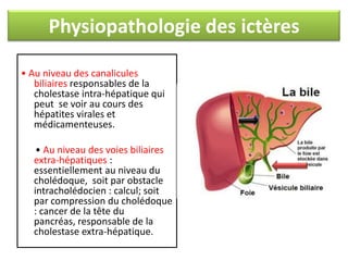Physiopathologie des ictères
• Au niveau des canalicules
biliaires responsables de la
cholestase intra-hépatique qui
peut se voir au cours des
hépatites virales et
médicamenteuses.
• Au niveau des voies biliaires
extra-hépatiques :
essentiellement au niveau du
cholédoque, soit par obstacle
intracholédocien : calcul; soit
par compression du cholédoque
: cancer de la tête du
pancréas, responsable de la
cholestase extra-hépatique.

 