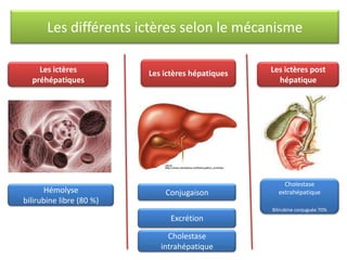 Les différents ictères selon le mécanisme
Les ictères
préhépatiques

Hémolyse
bilirubine libre (80 %)

Les ictères hépatiques

Conjugaison

Les ictères post
hépatique

Cholestase
extrahépatique
Bilirubine conjuguée 70%

Excrétion

Cholestase
intrahépatique

 