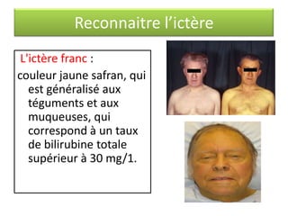 Reconnaitre l’ictère
L'ictère franc :
couleur jaune safran, qui
est généralisé aux
téguments et aux
muqueuses, qui
correspond à un taux
de bilirubine totale
supérieur à 30 mg/1.

 