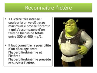 Reconnaitre l’ictère
• • L'ictère très intense :
couleur brun verdâtre au
maximum « bronze florentin
» qui s'accompagne d'un
taux de bilirubine totale
entre 300 et 400 mg/1.
• Il faut connaître la possibilité
d'un décalage entre
l'hyperbilirubinémie et
l'ictère :
l'hyperbilirubinémie précède
et survit à l'ictère.

 
