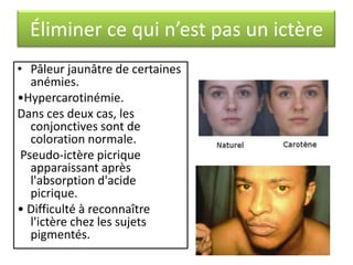 Éliminer ce qui n’est pas un ictère
• Pâleur jaunâtre de certaines
anémies.
•Hypercarotinémie.
Dans ces deux cas, les
conjonctives sont de
coloration normale.
Pseudo-ictère picrique
apparaissant après
l'absorption d'acide
picrique.
• Difficulté à reconnaître
l'ictère chez les sujets
pigmentés.

 