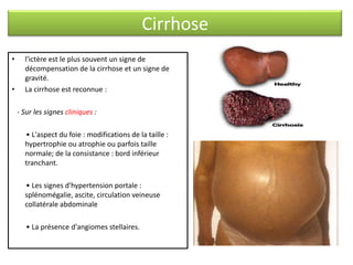 Cirrhose
•

•

l'ictère est le plus souvent un signe de
décompensation de la cirrhose et un signe de
gravité.
La cirrhose est reconnue :
- Sur les signes cliniques :
• L'aspect du foie : modifications de la taille :
hypertrophie ou atrophie ou parfois taille
normale; de la consistance : bord inférieur
tranchant.
• Les signes d'hypertension portale :
splénomégalie, ascite, circulation veineuse
collatérale abdominale
• La présence d'angiomes stellaires.

 