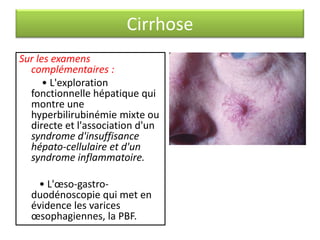 Cirrhose
Sur les examens
complémentaires :
• L'exploration
fonctionnelle hépatique qui
montre une
hyperbilirubinémie mixte ou
directe et l'association d'un
syndrome d'insuffisance
hépato-cellulaire et d'un
syndrome inflammatoire.
• L'œso-gastroduodénoscopie qui met en
évidence les varices
œsophagiennes, la PBF.

 