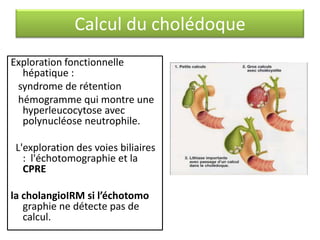 Calcul du cholédoque
Exploration fonctionnelle
hépatique :
syndrome de rétention
hémogramme qui montre une
hyperleucocytose avec
polynucléose neutrophile.
L'exploration des voies biliaires
: l'échotomographie et la
CPRE

la cholangioIRM si l’échotomo
graphie ne détecte pas de
calcul.

 