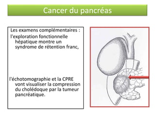 Cancer du pancréas
Les examens complémentaires :
l'exploration fonctionnelle
hépatique montre un
syndrome de rétention franc,

l'échotomographie et la CPRE
vont visualiser la compression
du cholédoque par la tumeur
pancréatique.

 