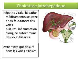 Cholestase intrahépatique
hépatite virale, hépatite
médicamenteuse, canc
er du foie,cancer des
voies
biliaires, inflammation
d’origine autoimmune
des voies biliaires
kyste hydatique fissuré
dans les voies biliaires.

 