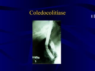 Coledocolitíase
 
